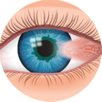 pterygium-200×200 Eye Examination